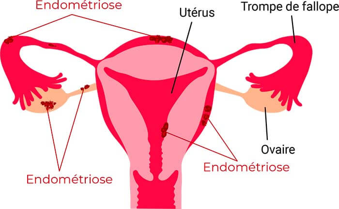 endometriose psychologue sexologue naturopathe